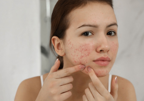 acne scars treatment in rajouri garden