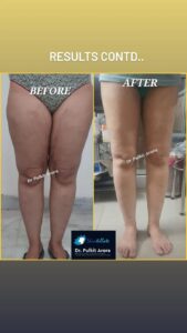 thigh liposuction results treatment doctor in rajouri garden new delhi