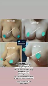 top breast reduction surgery results treatment doctor in rajouri garden