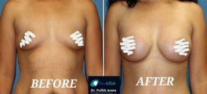 top fat transfer to breasts results treatment doctor in rajouri garden new delhi